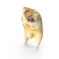 Broken Left Molar with Cavity Upper Jaw PNG & PSD Images