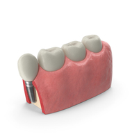 Education Tooth Implant Model PNG & PSD Images