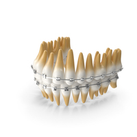 Teeth with Braces Model PNG & PSD Images