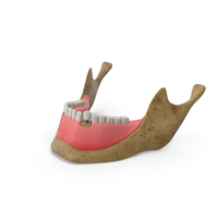 Dental Implant PNG & PSD Images