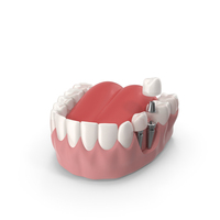 Mouth Implant Model PNG & PSD Images
