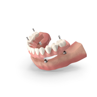 Implant Supported Denture PNG & PSD Images