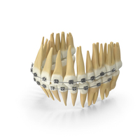 Dentition With Self Ligating Steel Dental Braces PNG & PSD Images