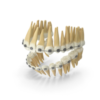 Dentition With Self Ligating Steel Dental Braces PNG & PSD Images