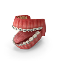 Human Mouth With Self Ligating Steel Dental Braces PNG & PSD Images