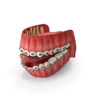 Human Mouth With Self Ligating Steel Dental Braces PNG & PSD Images