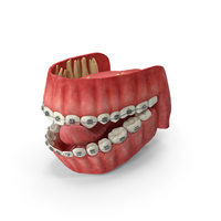 Human Mouth With Self Ligating Steel Dental Braces PNG & PSD Images