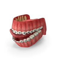 Human Mouth With Self Ligating Steel Dental Braces PNG & PSD Images