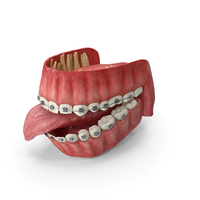 Human Mouth With Self Ligating Steel Dental Braces PNG & PSD Images
