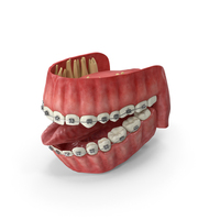 Human Mouth With Self Ligating Steel Dental Braces PNG & PSD Images