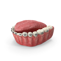 Human Lower Jaw With Self Ligating Steel Dental Braces PNG & PSD Images
