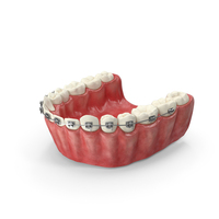 Human Lower Jaw With Self Ligating Steel Dental Braces PNG & PSD Images