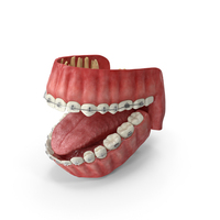 Human Mouth With Self Ligating Transparent Dental Braces PNG & PSD Images