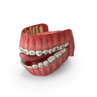 Human Mouth With Self Ligating Transparent Dental Braces PNG & PSD Images