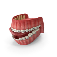 Human Mouth With Self Ligating Transparent Dental Braces PNG & PSD Images