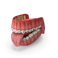 Human Mouth With Self Ligating Transparent Dental Braces PNG & PSD Images
