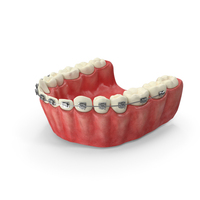 Human Lower Jaw With Self Ligating Steel Dental Braces PNG & PSD Images