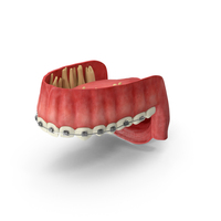 Human Upper Jaw With Self Ligating Steel Dental Braces PNG & PSD Images