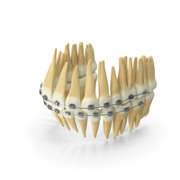 Dentition With Self Ligating Steel Dental Braces V03 PNG & PSD Images