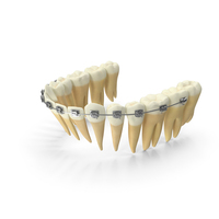 Lower Jaw Dentition With Self Ligating Steel Dental Braces PNG & PSD Images