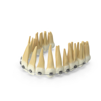 Upper Jaw Dentition With Self Ligating Steel Dental Braces V02 PNG & PSD Images