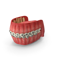 Human Mouth With Self Ligating Steel Dental Braces PNG & PSD Images