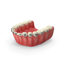Human Lower Jaw With Self Ligating Steel Dental Braces PNG & PSD Images