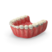 Human Lower Jaw With Self Ligating Transparent Dental Braces PNG & PSD Images