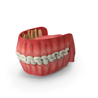 Human Mouth With Self Ligating Transparent Dental Braces PNG & PSD Images