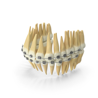 Dentition With Self Ligating Steel Dental Braces PNG & PSD Images