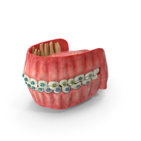 Human Mouth With Steel Dental Braces PNG & PSD Images