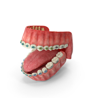 Human Mouth With Steel Dental Braces PNG & PSD Images