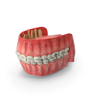 Human Mouth With Transparent Dental Braces PNG & PSD Images