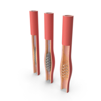 Stents With Artery PNG & PSD Images