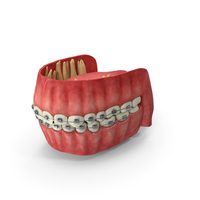 Human Mouth With Self Ligating Steel Dental Braces PNG & PSD Images