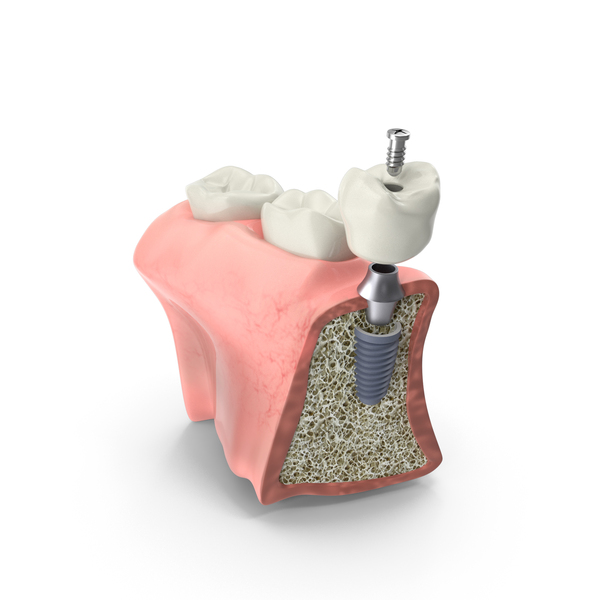 Teeth: Dental Implant Section PNG & PSD Images Teeth: Dental Implant Section PNG & PSD Images