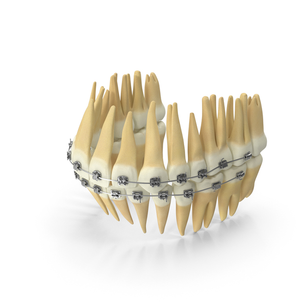 Dentition With Self Ligating Steel Dental Braces PNG & PSD Images Dentition With Self Ligating Steel Dental Braces PNG & PSD Images