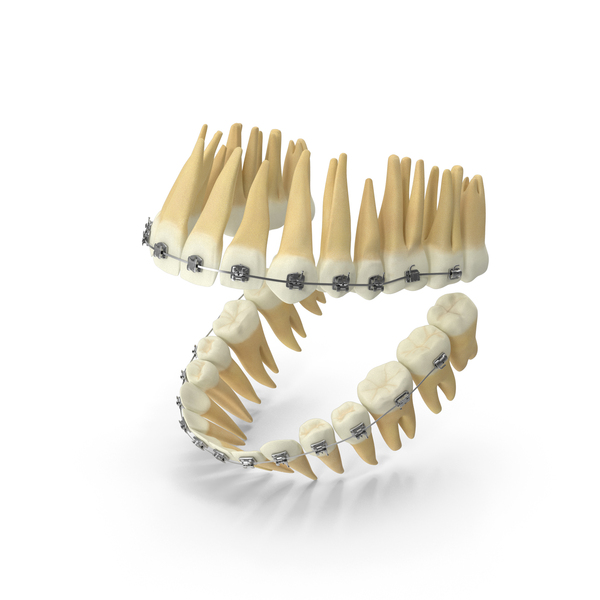 Dentition With Self Ligating Steel Dental Braces PNG & PSD Images Dentition With Self Ligating Steel Dental Braces PNG & PSD Images