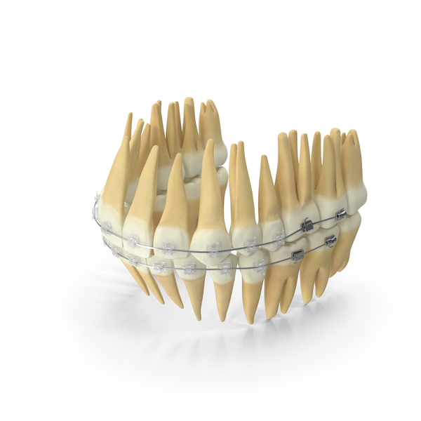 Dentition With Self Ligating Transparent Dental Braces PNG & PSD Images Dentition With Self Ligating Transparent Dental Braces PNG & PSD Images