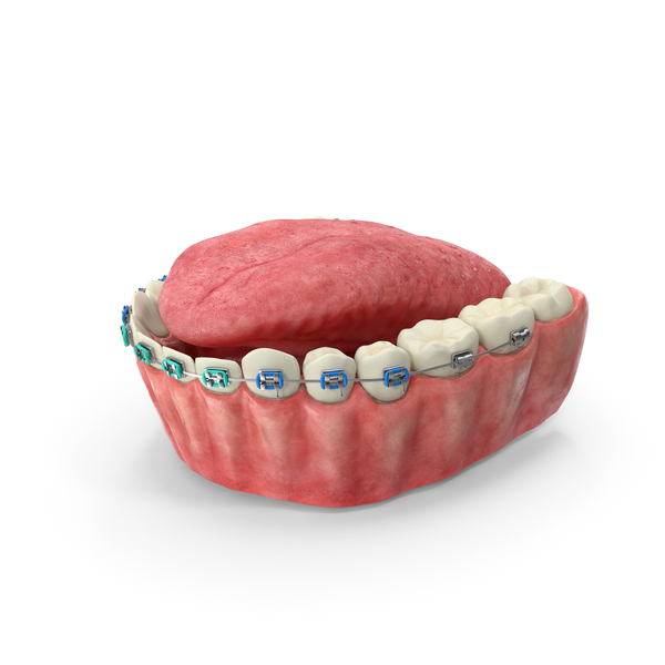 Human Lower Jaw And Tongue With Steel Dental Braces PNG & PSD Images Human Lower Jaw And Tongue With Steel Dental Braces PNG & PSD Images