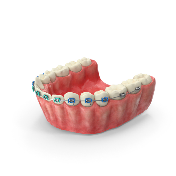 Human Lower Jaw With Steel Dental Braces PNG & PSD Images Human Lower Jaw With Steel Dental Braces PNG & PSD Images